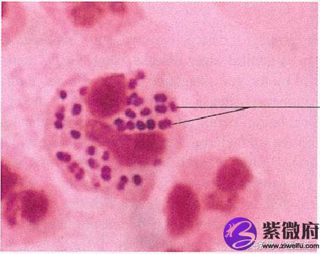星座链球菌感染孕妇